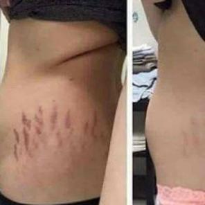 Intensive stretch mark removal cream!