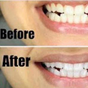 Charcoal teeth whitening