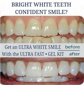•WHITE TEETH FAST GEL KIT + MYSTERY GIFT