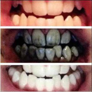 ✨✨✨✨✨ CLEANER, WHITER, TEETH GUARANTEED!