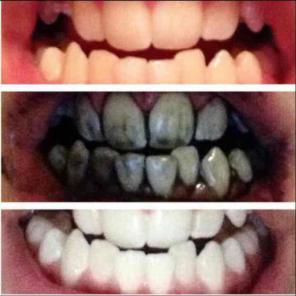 ⭐️⭐️⭐️⭐️⭐️5STAR! Teeth WHITENING Kit!!