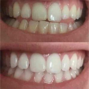 Get CLEANER, WHITER, HEALTHIER Teeth!!!