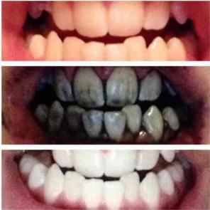 'Organic teeth whitening