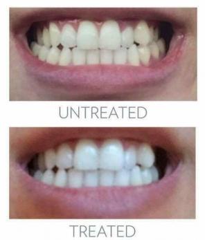 Whitening toothpaste
