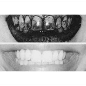 CLEANER, WHITER SMILE using Charcoal!!