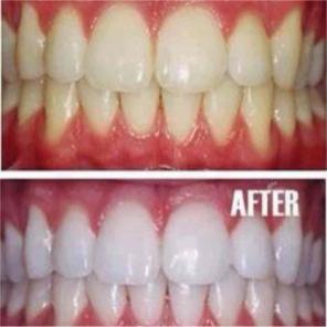 Teeth whitening charcoal sale
