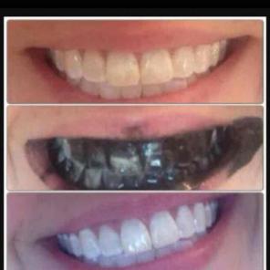 Organic teeth whitening free shipping