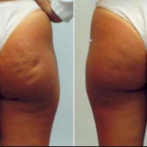 Powerful Cellulite reducing bath soak!