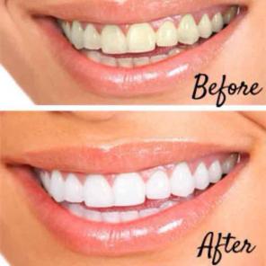 Teeth whitening sale organic new